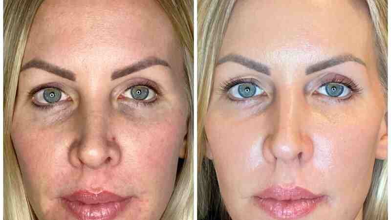 full face fibroblast before and after